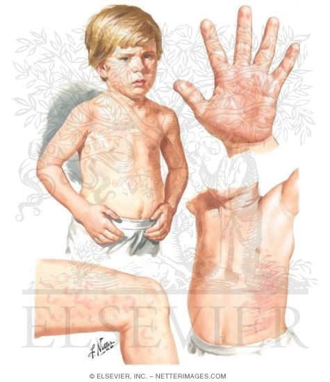 Characteristic Rash of Juvenile Rheumatoid Arthritis (JRA) Compared to Rheumatic Fever Rash