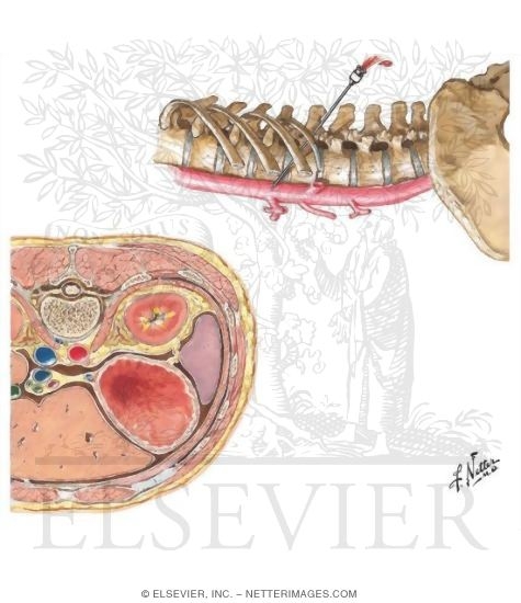 Aortorenal Angiography: Translumbar Approach