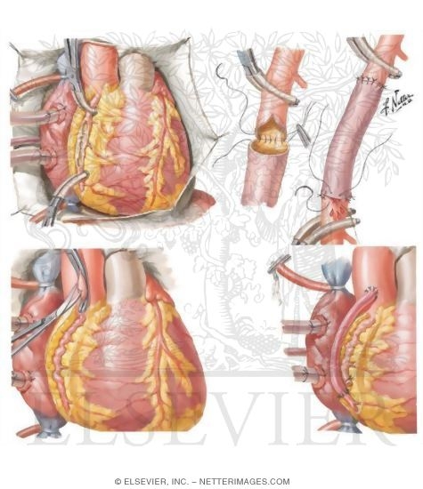 aortocoronary bypass