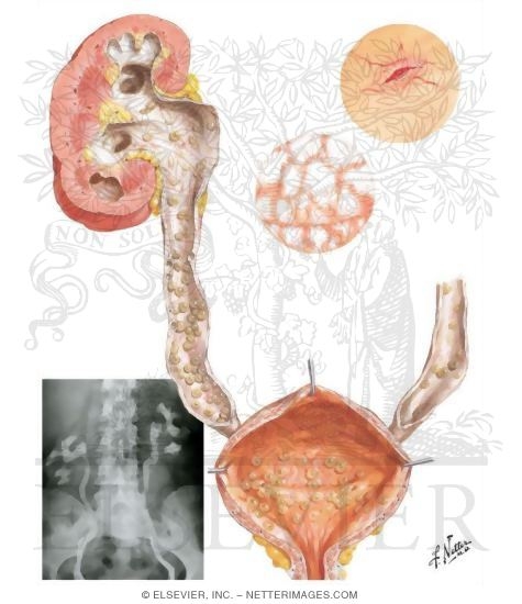 Cystitis
