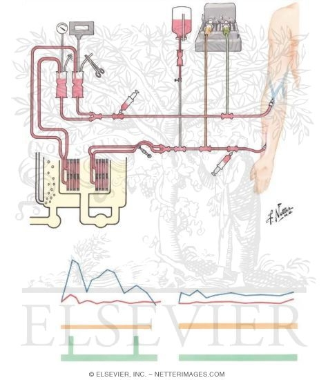Hemodialysis