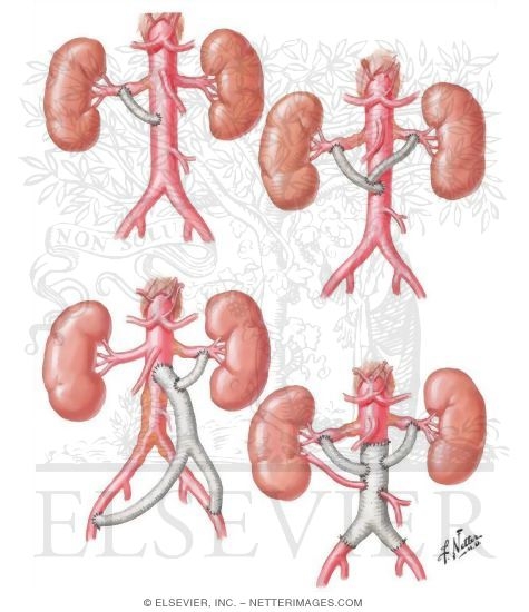 Renal Revascularization