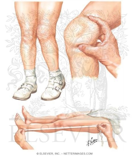 Monarticular Juvenile Rheumatoid Arthritis Involving the Knee