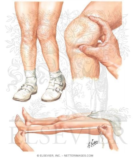 Monarticular Juvenile Rheumatoid Arthritis Involving the Knee Monarticular Juvenile Rheumatoid Arthritis Involving the Knee