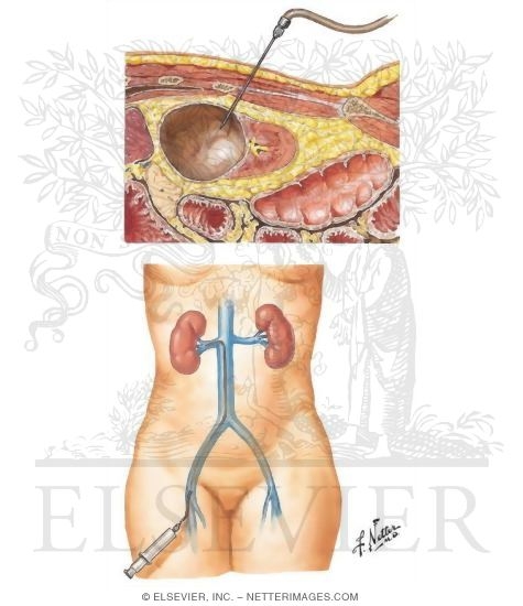 Renal Cyst Puncture and Venous Studies