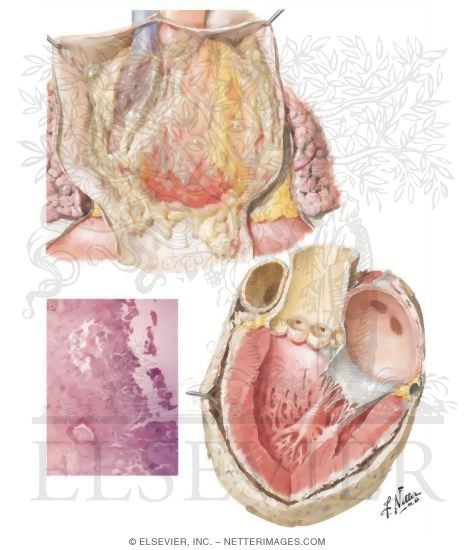Diseases of Pericardium