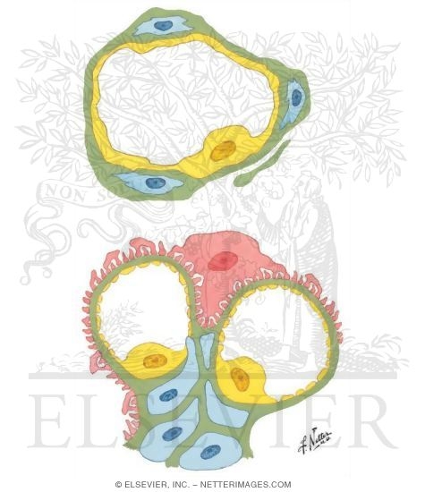 Diabetic Nephropathy: Ultramicroscopic Structure of Skin Capillaries and Glomerular Capillaries