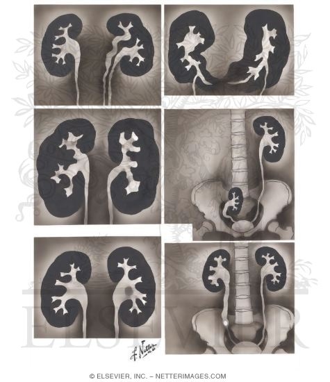 Exemplary Abnormalities Which May Appear On the Intravenous Pyelogram
