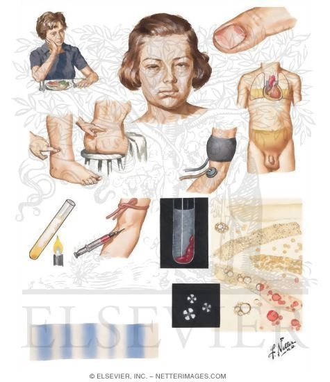 Clinical and Laboratory Findings Which May Be Present in Nephrotic Syndrome