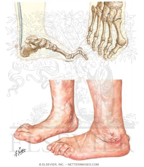 The Feet In Rheumatoid Arthritis