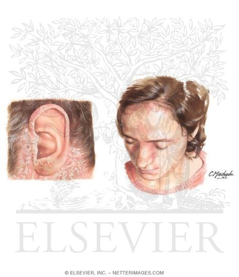 Sebhorrheic Dermatitis