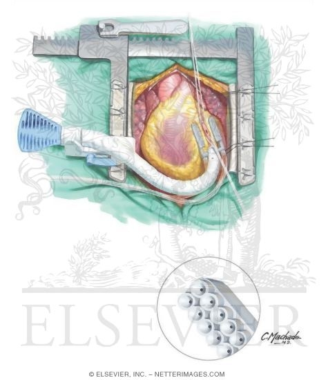 aortocoronary bypass