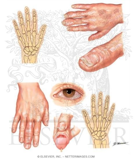 diagnosis of arthritis