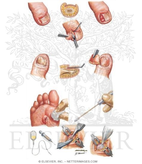Common Infections of Foot