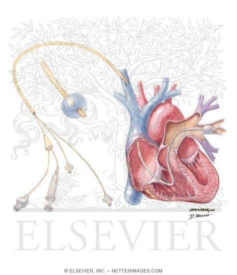 Right Heart Cath