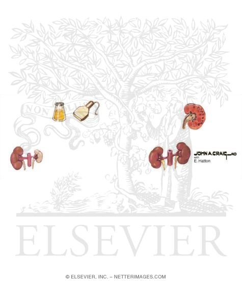 Evaluation and Management of Renal Artery Stenosis