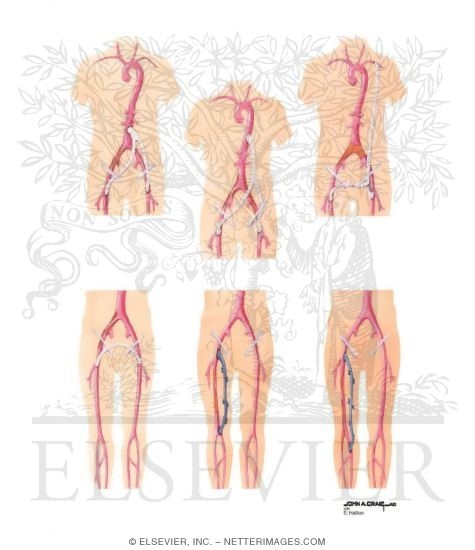 Surgical Management of Peripheral Arterial Disease of Lower Extremity