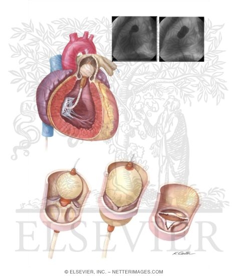 Balloon Aortic Valvuloplasty