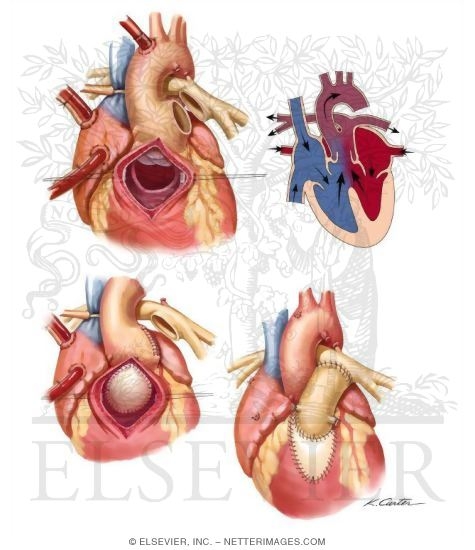 Arterial Repair of Transposition of the Great Arteries
