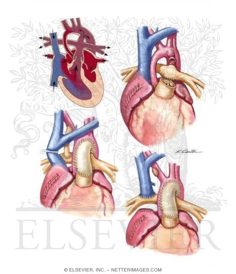 Norwood Correction of HLHS