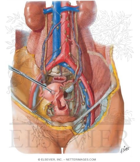 Lymph Vessels and Nodes of Pelvis and Genitalia: Female
Lymphatic Drainage II - Internal Genitalia