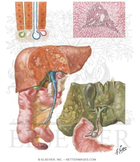 Bacterial Hepatitis