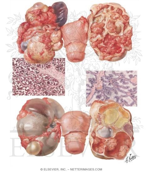 Carcinoma - Primary Cystic Carcinoma, Primary Solid Carcinoma, Secondary Ovarian Carcinoma