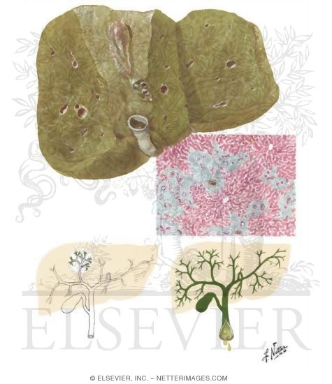 Biliary Cirrhosis