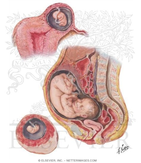 Ectopic Pregnancy III - Interstitial, Abdominal, Ovarian