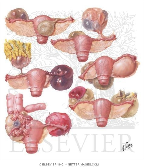 Diagnosis of Ovarian Neoplasms