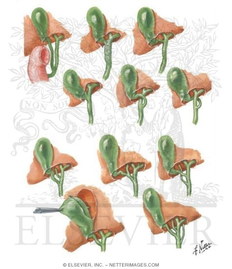 Variations In Cystic and Hepatic Ducts