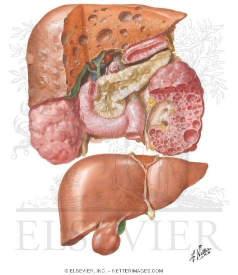 Congenital Anomalies - Liver