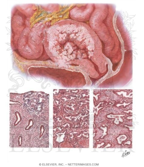 Cancer of Corpus II - Histology and Extension