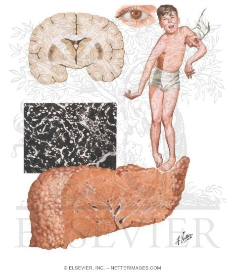 Metabolic Injuries III - Wilson Disease