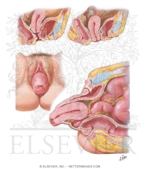 Uterine Prolapse