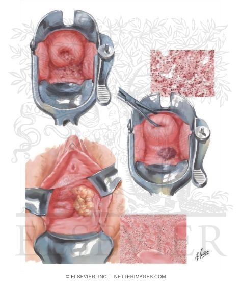 Malignant Tumors II - Metastases and Extension