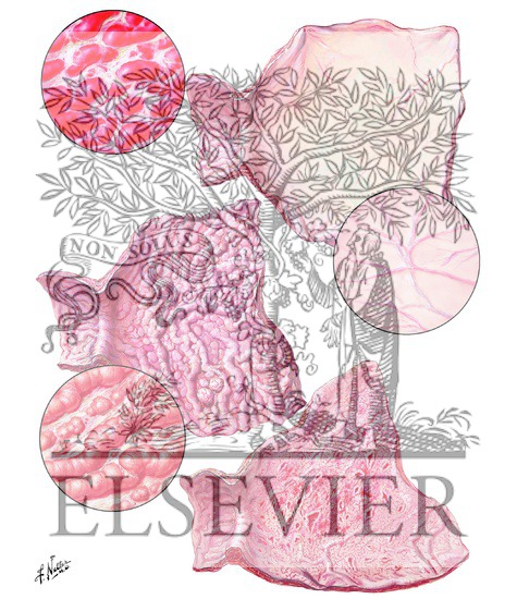 Gastritis