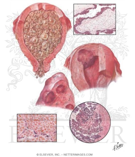 Gestational Trophoblastic Disease