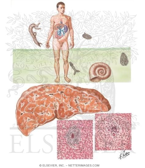 Schistosomiasis
