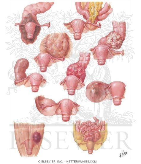 Conditions Simulating Ovarian Neoplasms - Differential Diagnosis