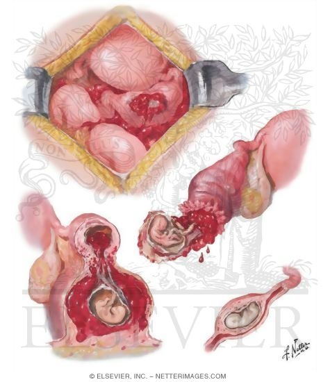 Ectopic Pregnancy II - Rupture, Abortion