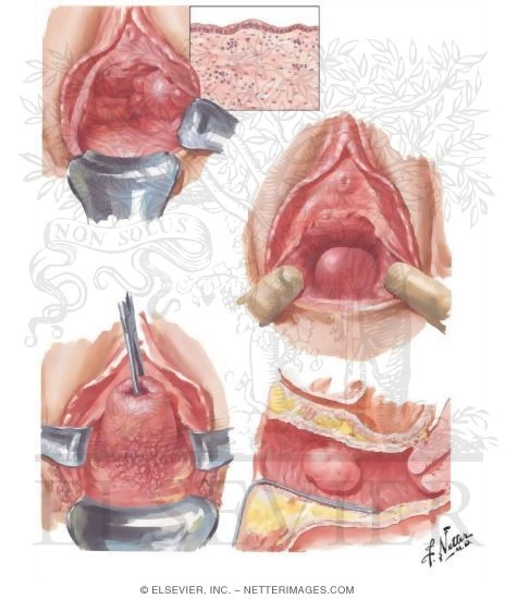 Benign Tumors In Vagina 26