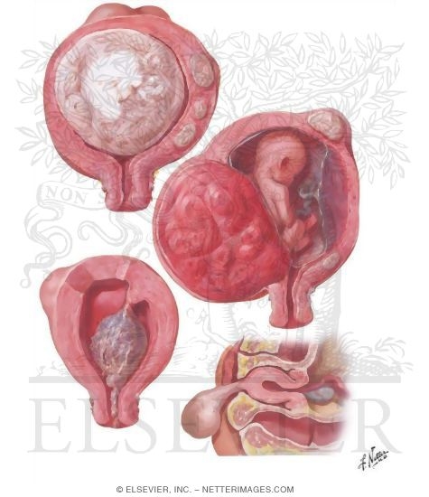Myoma (Fibroid) II - Secondary Changes - Netter Medical Artwork