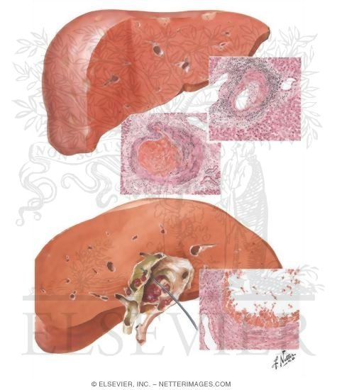 Vascular Disturbances III - Periarteritis Nodosa, Aneurysm