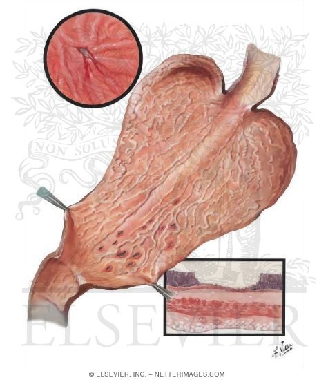 Peptic Ulcer I - Acute Gastric Ulcer