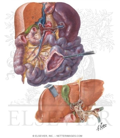 Vascular Disturbances II - Portal Vein