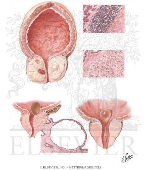 Infarct, Retention Cyst