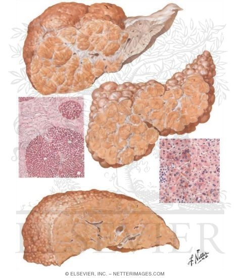 Postnecrotic Cirrhosis