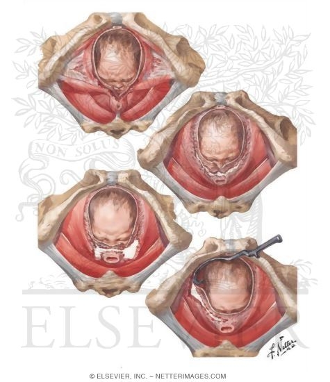 Obstetric Lacerations I - Vaginal Support and Muscles