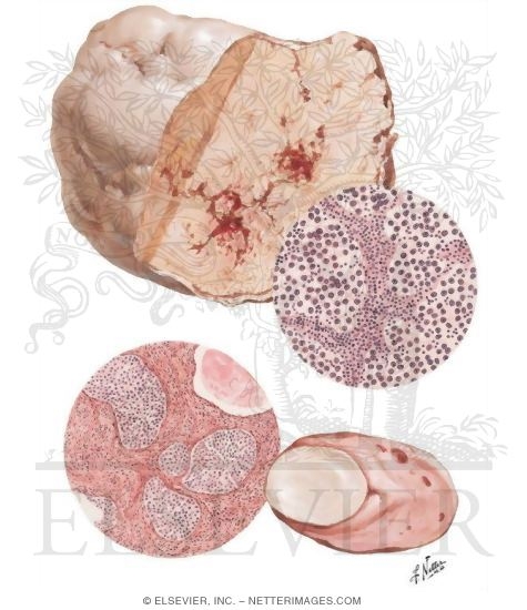 Dysgerminoma, Brenner Tumor